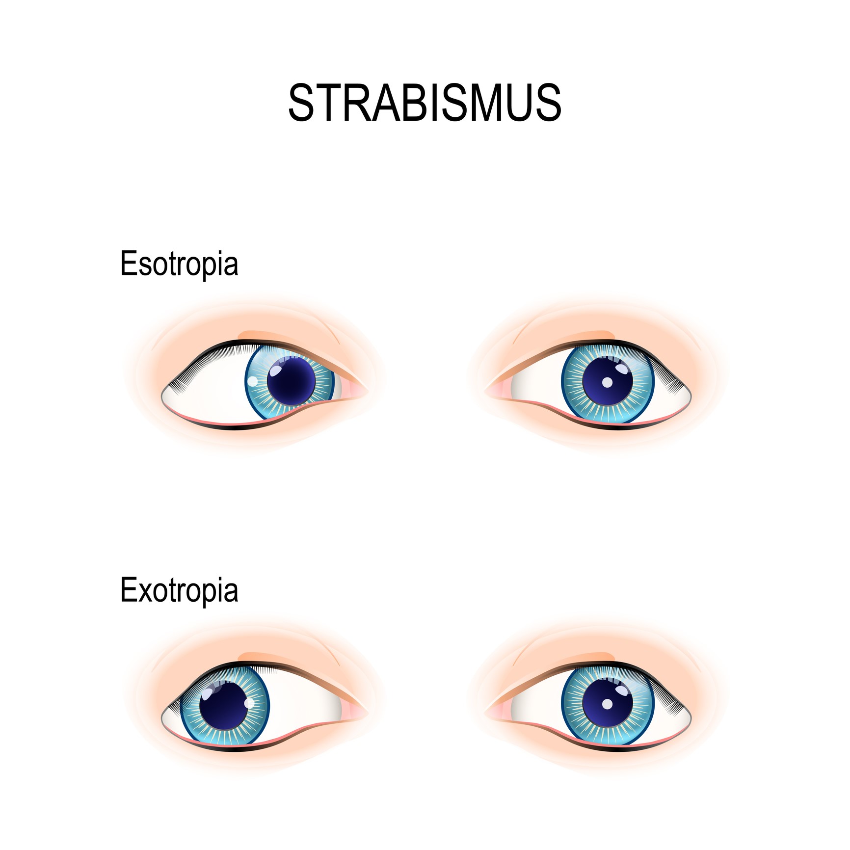 Eye syndrome wandering Parinaud Syndrome